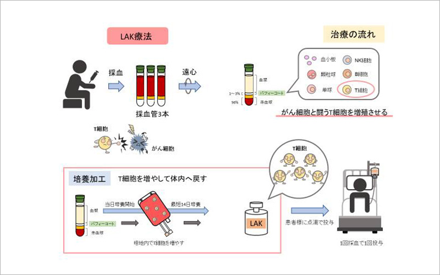  活性リンパ球療法の図解